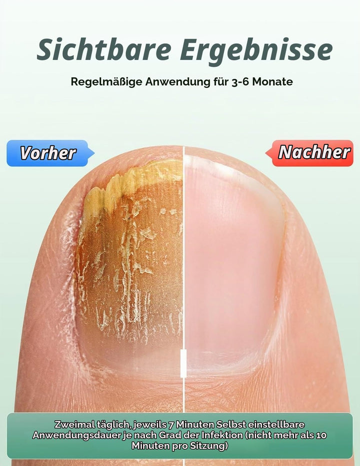 2025 Upgrade Nagelpilz Lasergerät, Nagelpilz Laser Gerät für Mehrere &amp; Fingernägel Lichttherapiegerä