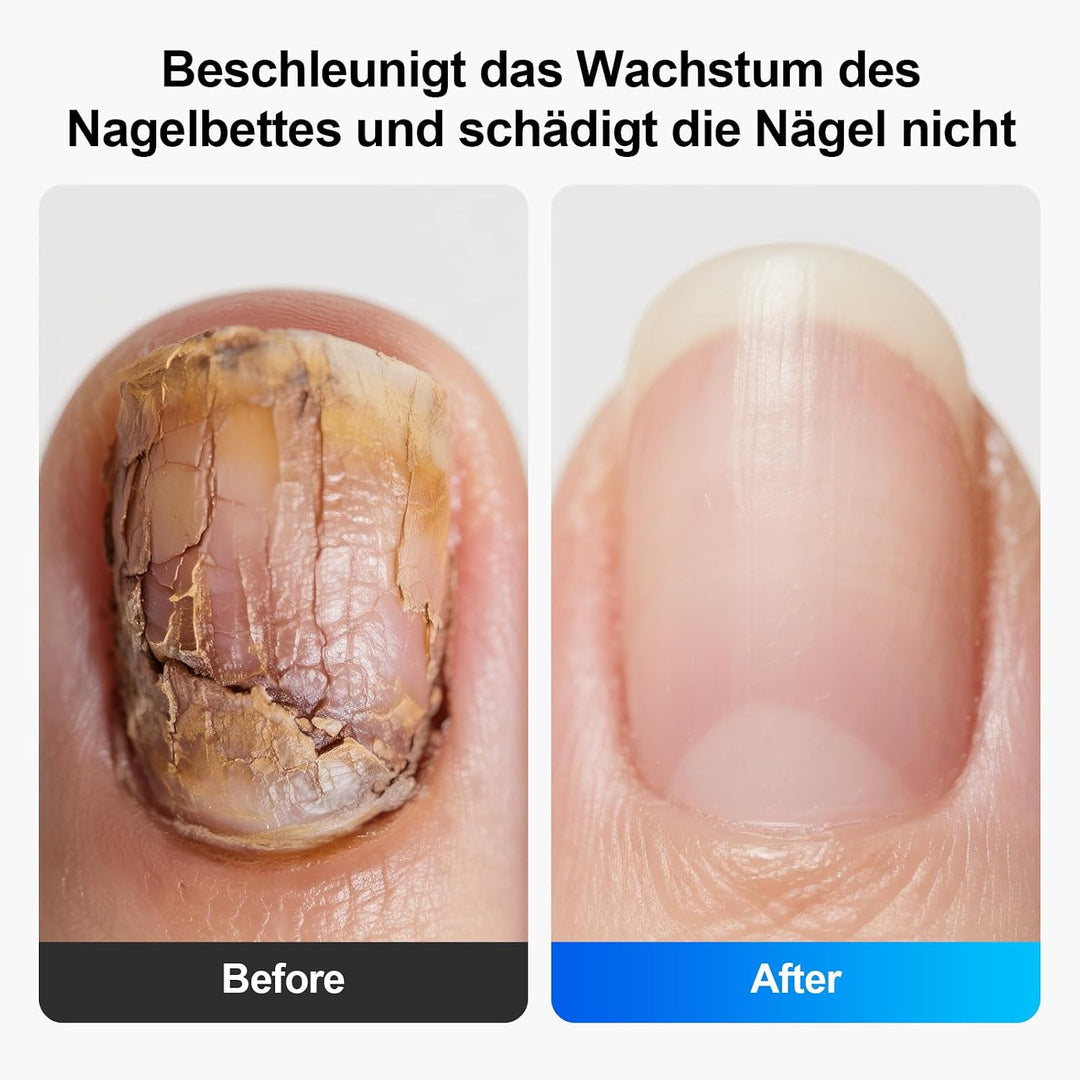 LED Nagelpflegegerät, 500 nm Blaulicht und 940 nm Rotlicht, 21 Tage, für Finger- und Zehennägel, mit