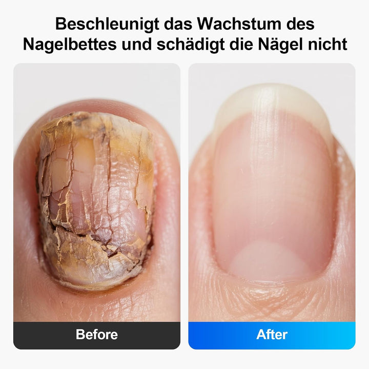 LED Nagelpflegegerät, 500 nm Blaulicht und 940 nm Rotlicht, 21 Tage, für Finger- und Zehennägel, mit