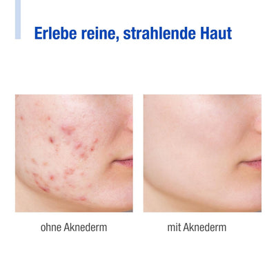 Aknederm Creme intens 2 x 30g für alle Hauttypen - entzündungshemmende Anti Pickel Creme mit Zink -
