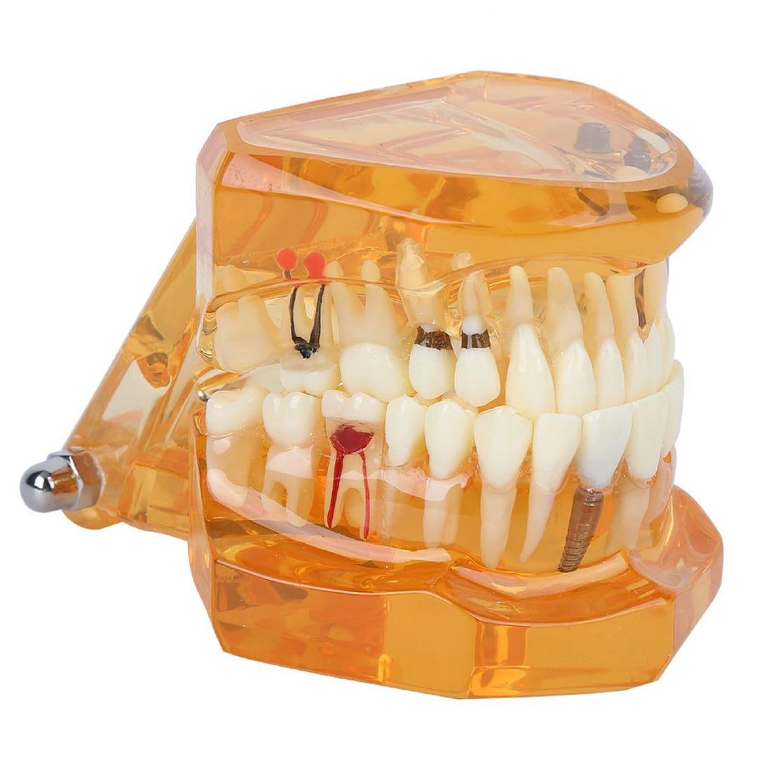 Natudeco Zahnärztliche Studienmodell untersuchen Modell Dental Maxillary Overdenture Model Minderwer