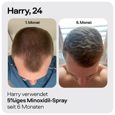 Sons Minoxidil 5% Lösung zur äusseren Anwendung, Haarwuchs & Verdichtung, Bei Haarausfall & lichtem