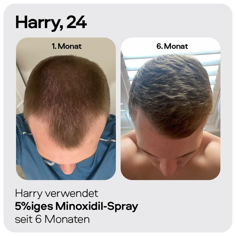 Sons Minoxidil 5% Lösung zur äusseren Anwendung, Haarwuchs & Verdichtung, Bei Haarausfall & lichtem