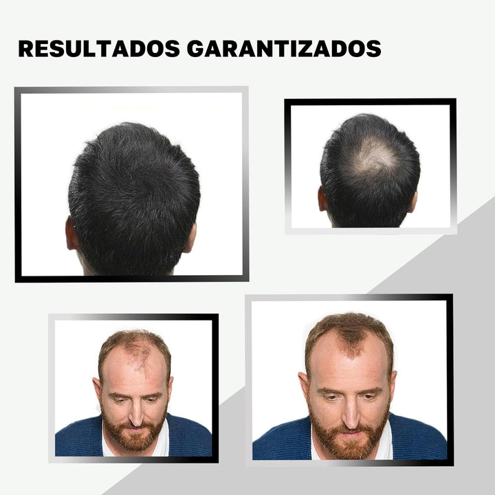 VidalForce. Streuhaar Schwarz 30gr I 100% Natürlich Ansatzpuder I Dichtes Haar in 20 Sekunden I Ansa