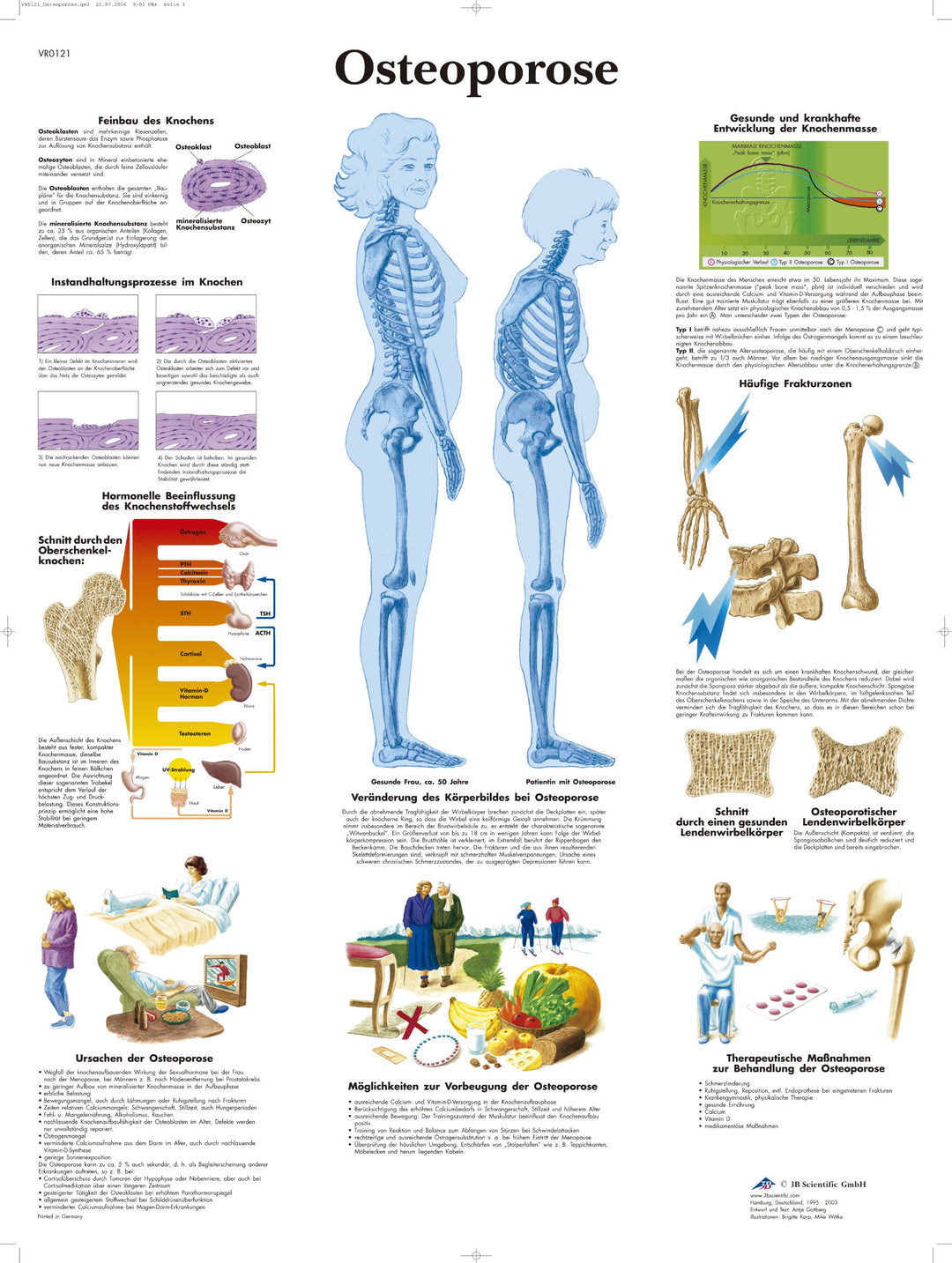 3B Scientific Lehrtafel - Osteoporose Papier, Papier