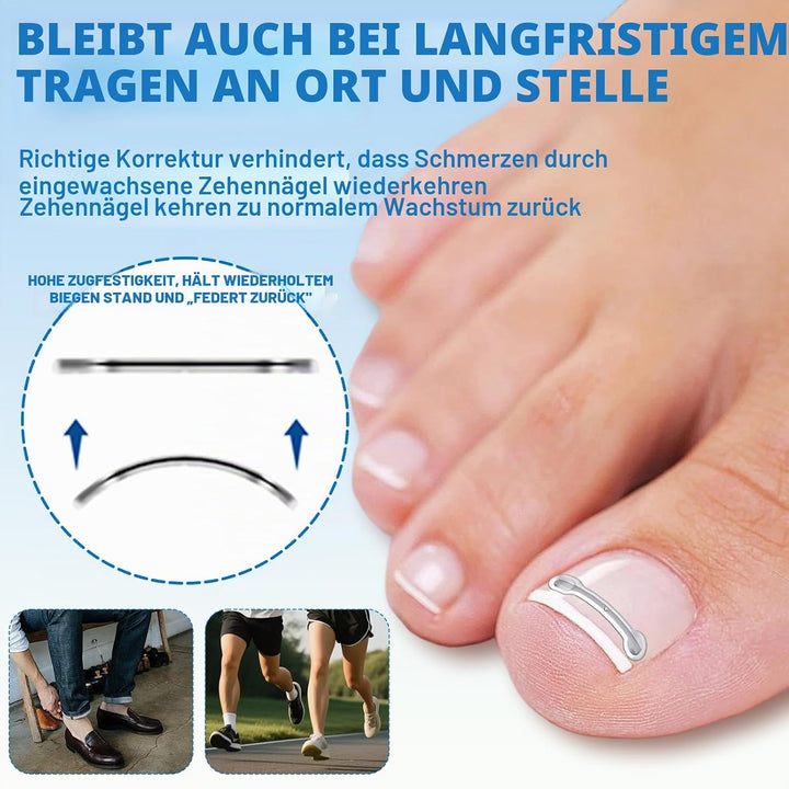 Eingewachsene Zehennägel Werkzeug Set, Nagel-korrekturspange, Zehennägel Korrektur Patch, Nagelspang