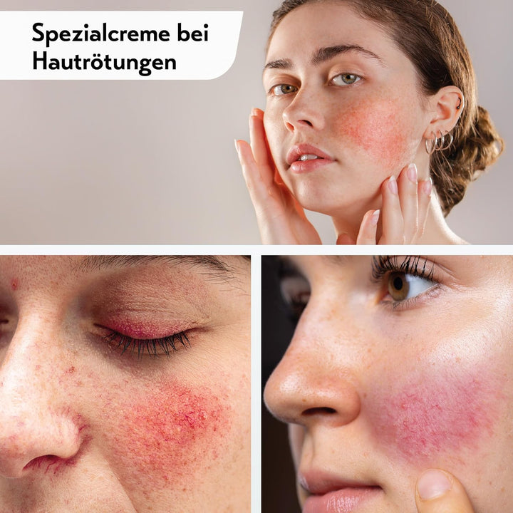 Deruba – Creme bei Rötungen mit LSF 50+ – von Dermaexperten entwickelt – 30 ml