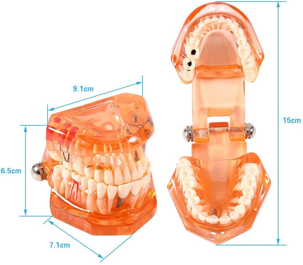 Jadeshay Zahnmodell Dentalmodell, Entfernbares Zahn-Implantat Lehrmodell Zahnarzt Demonstration Werk
