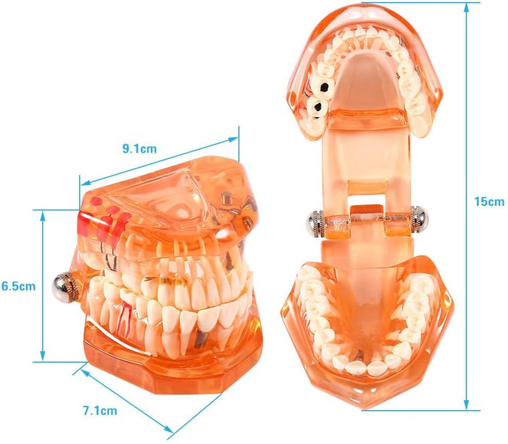Jadeshay Zahnmodell Dentalmodell, Entfernbares Zahn-Implantat Lehrmodell Zahnarzt Demonstration Werk