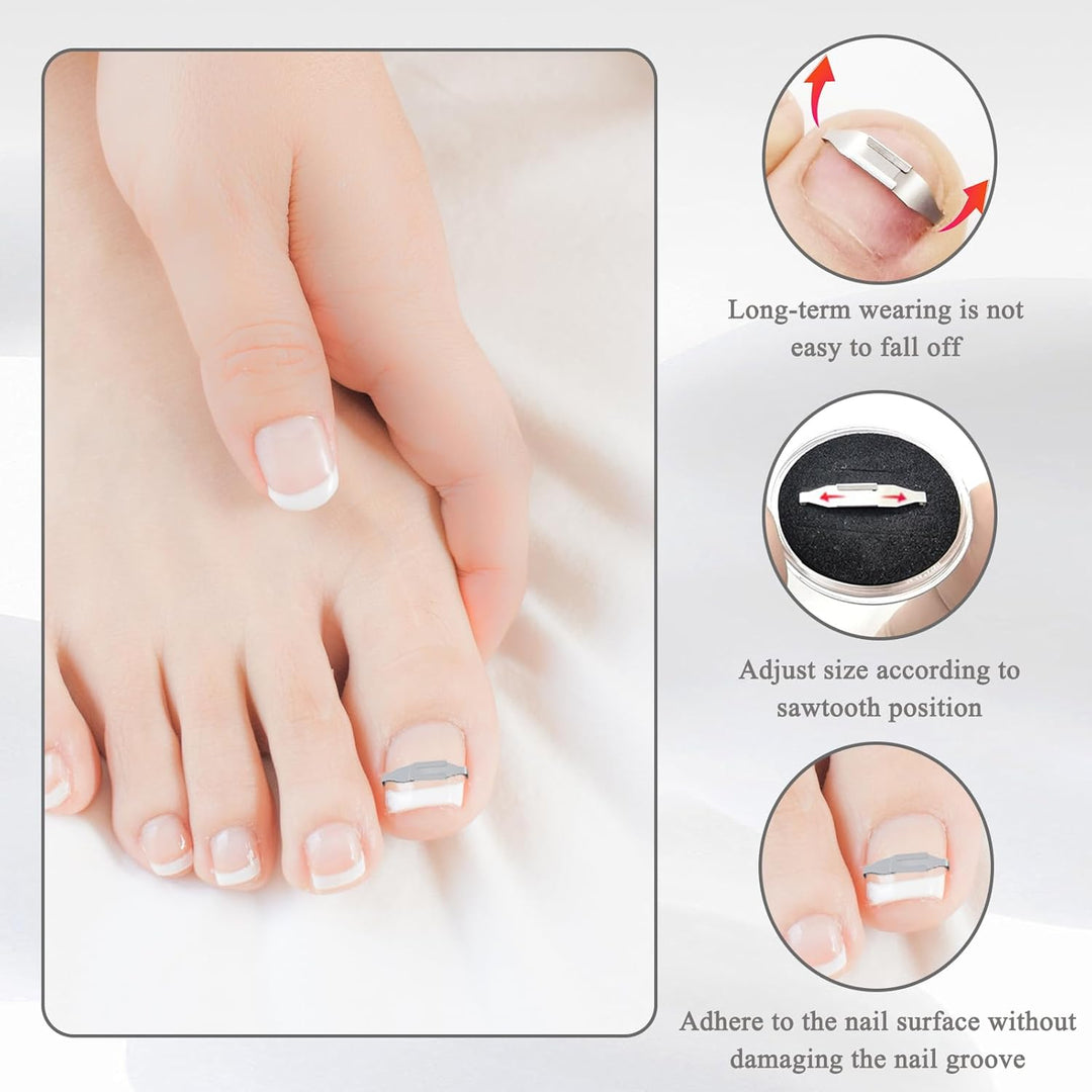 4 Stück Eingewachsene Zehennägel Set Fussnagel Eingewachsen Spange Nagelspangen Für Fussnägel Zehenn