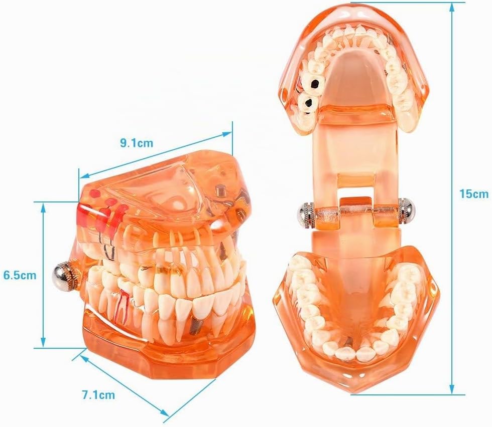 Jadeshay Zahnmodell Dentalmodell, Entfernbares Zahn-Implantat Lehrmodell Zahnarzt Demonstration Werk