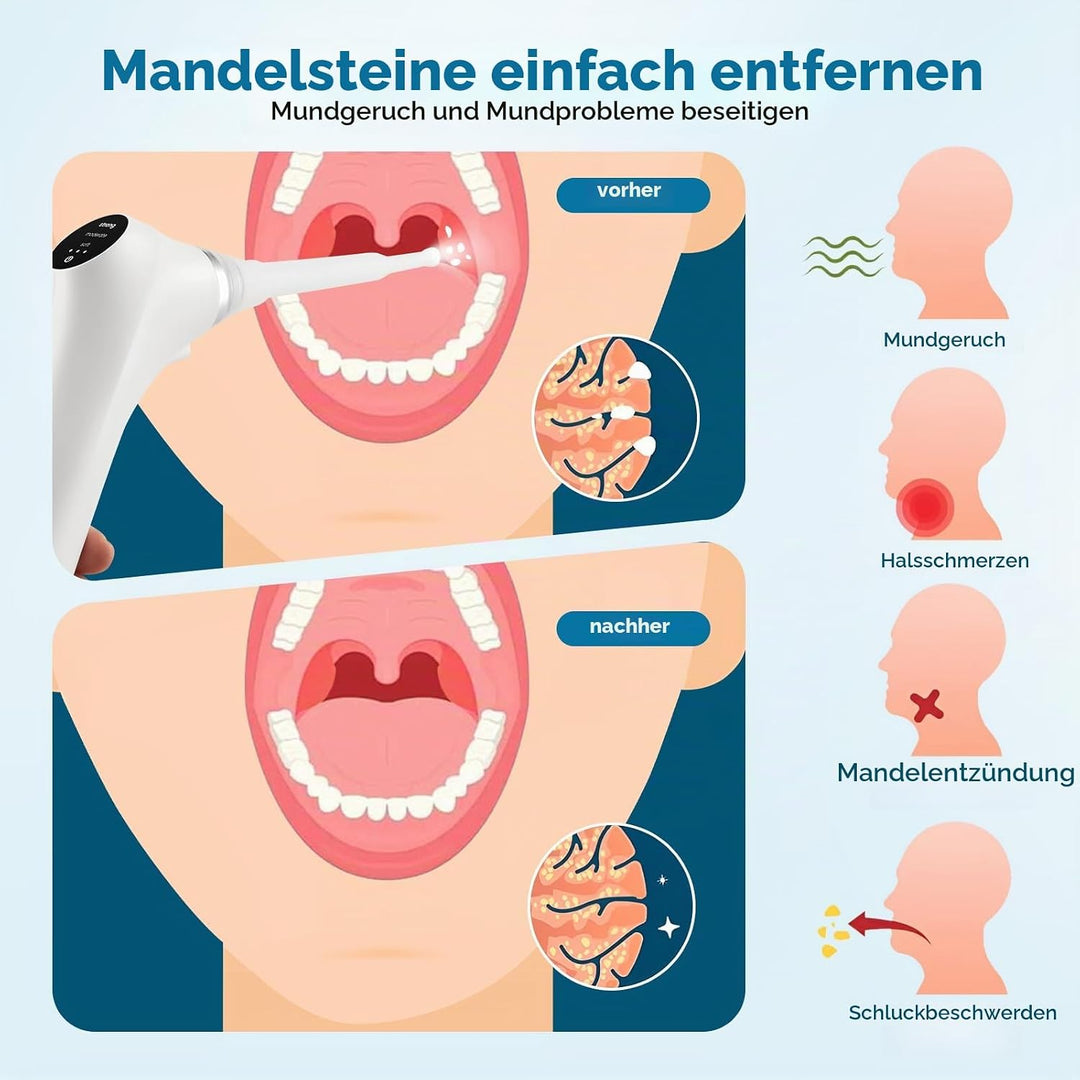 Tonsillenstein Entferner Elektrisch, Mandelsteine Entfernen Sauger mit 3 Silikonaufsätze &amp; LED, Mund