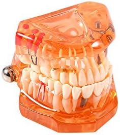 Jadeshay Zahnmodell Dentalmodell, Entfernbares Zahn-Implantat Lehrmodell Zahnarzt Demonstration Werk