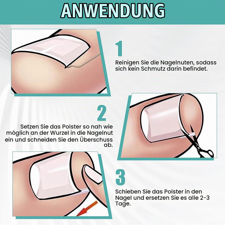 152 Pcs Nagelspange FussNäGel,Eingewachsene ZehennäGel Set,Zehennagel Eingewachsen,Nagelspange FussN