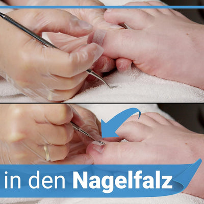 Kosmetex Set Tamponade 5 mtr, 1x Tamponierhaken, 1x Zehenbinde, Nagelfalztamponade für eingewachsene