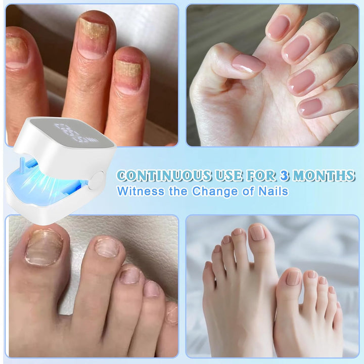 Upgrade Nagelpilz Lasergerät mit Zeitanzeige,Nagelpilz Laser mit Zeitmessgerät, Nagelpilz Behandlung