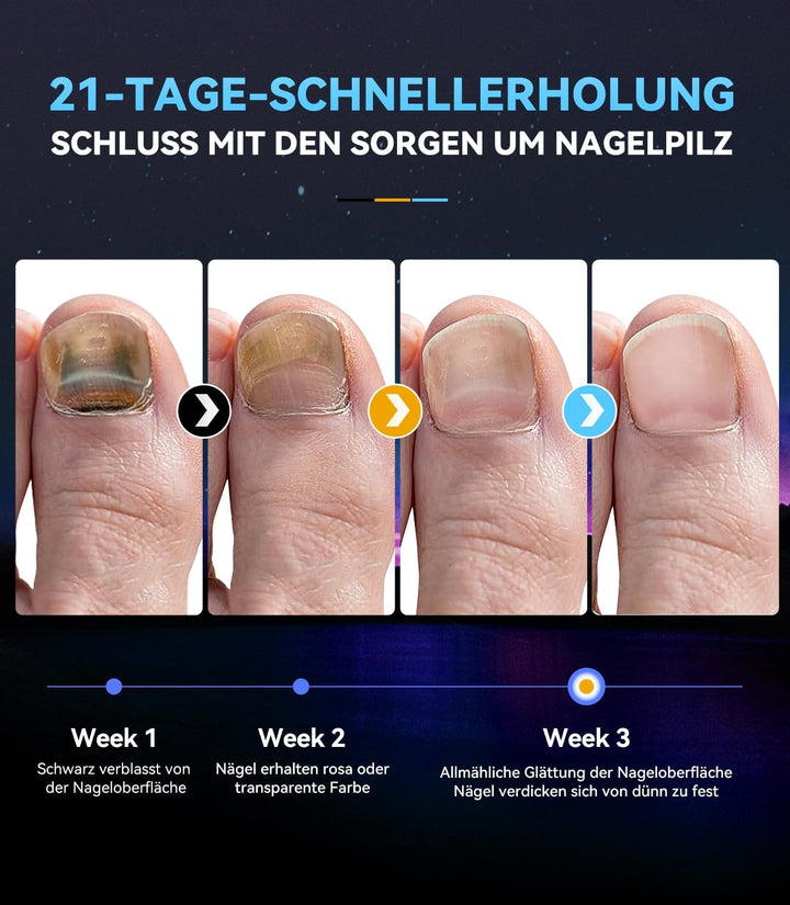 Neues 3.0 Upgrade Nagelpil Laser Gerät【7 Tage Schnell Wirkende】【mit Zeitanzeige - Nagelpil Lasergerä