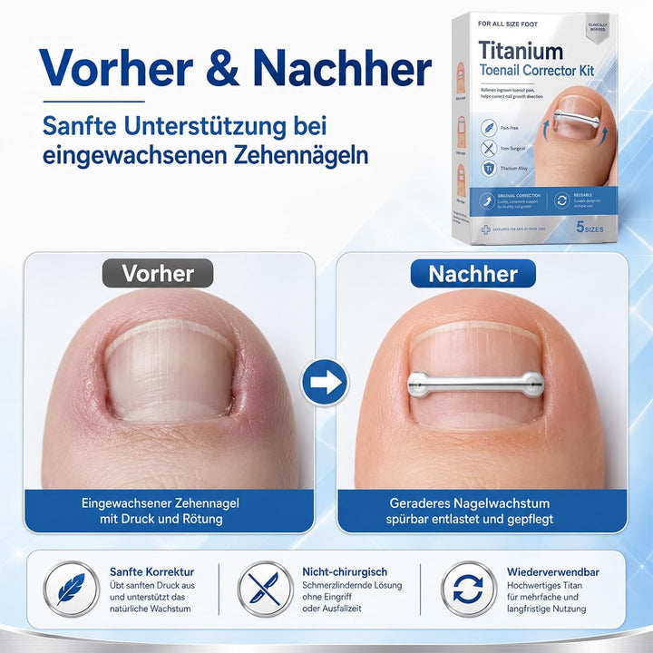Eingewachsene Zehennägel Set, Korrekturstreifen | für Eingewachsene Zehennägel, Professionelle Anwen