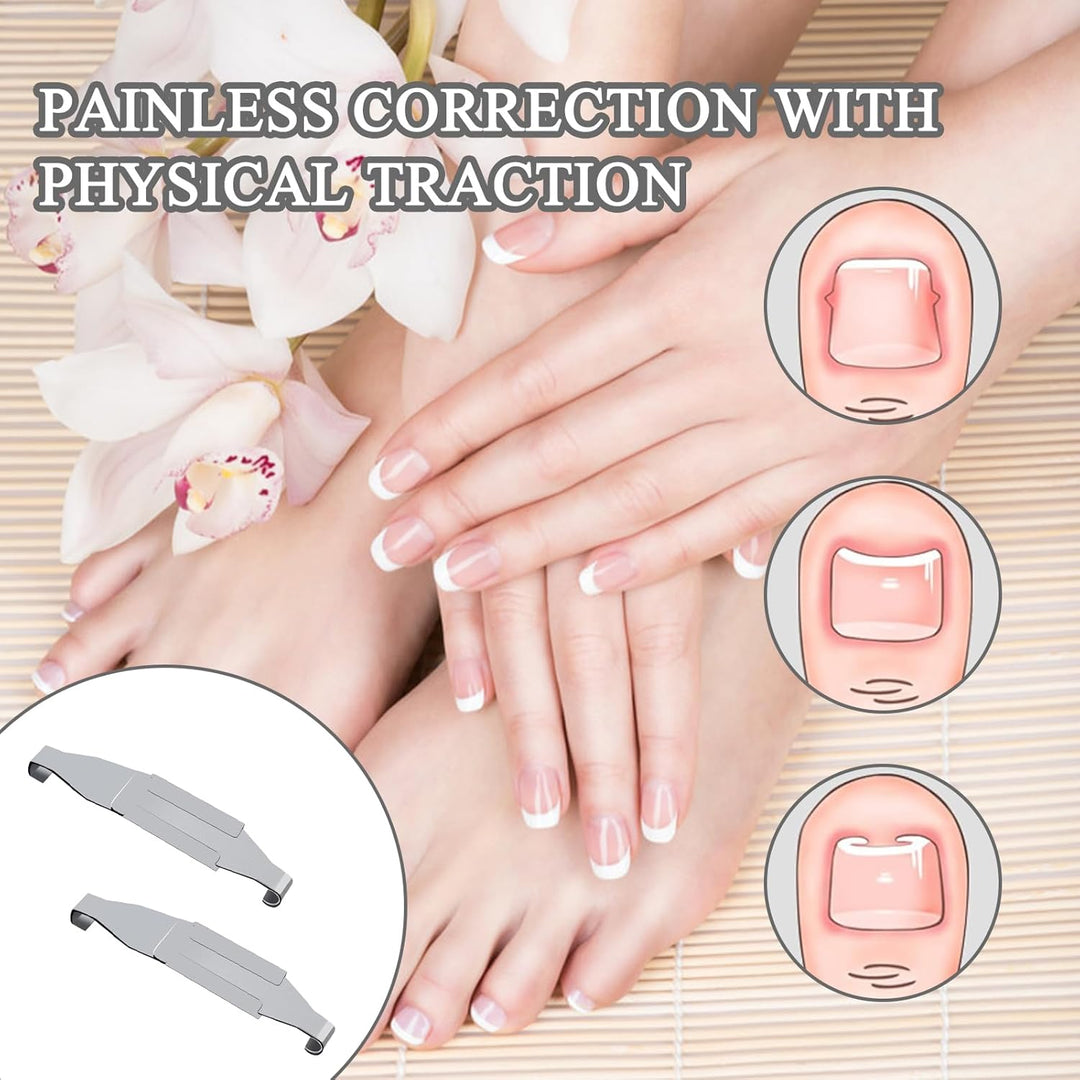 4 Stück Eingewachsene Zehennägel Set Fussnagel Eingewachsen Spange Nagelspangen Für Fussnägel Zehenn