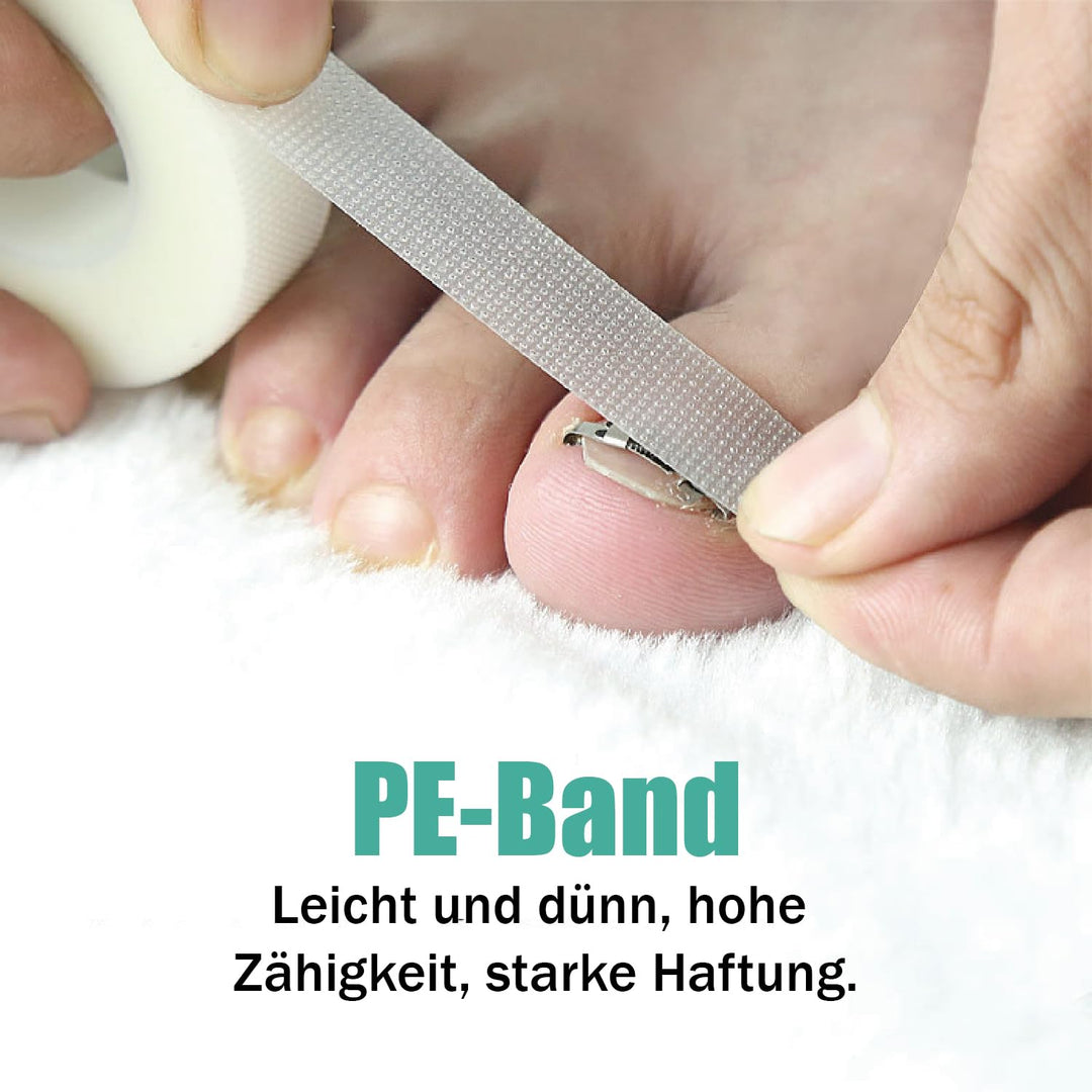 1 Satz Eingewachsene Zehennagel-Werkzeuge, Nagel-Korrekturschnalle, Patch Gebogene Zehennägel Klamme