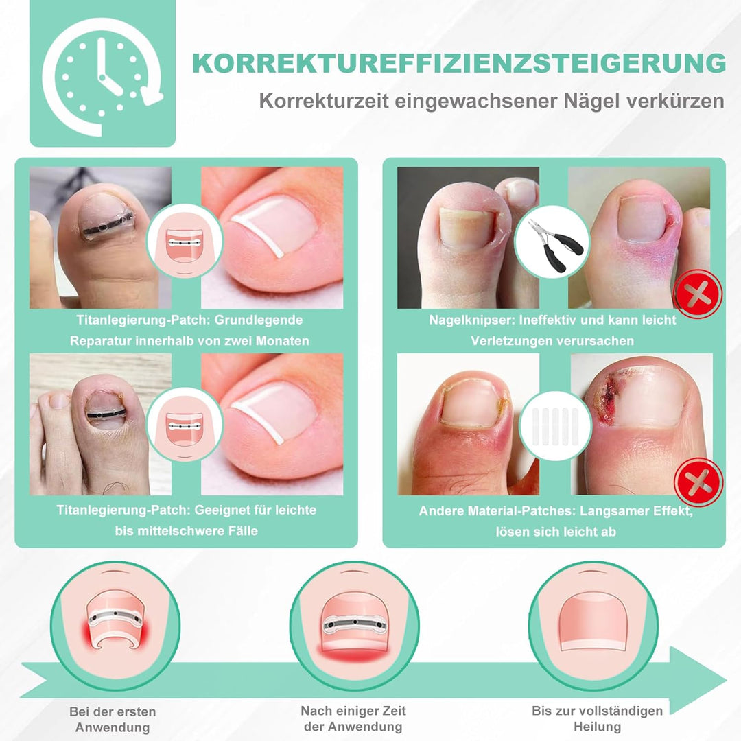 Eingewachsene Zehennägel Set Zehennagel Korrektur Patch 9pcs Nagelspange Fussnägel Zehennagelheber W