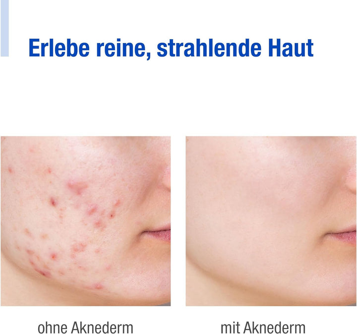 Aknederm Creme 2 x 30g - mattierende Gesichtscreme gegen Pickel &amp; unreine Haut - talgregulierende Fe