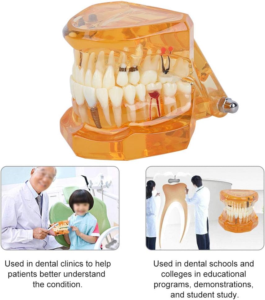 Natudeco Zahnärztliche Studienmodell untersuchen Modell Dental Maxillary Overdenture Model Minderwer