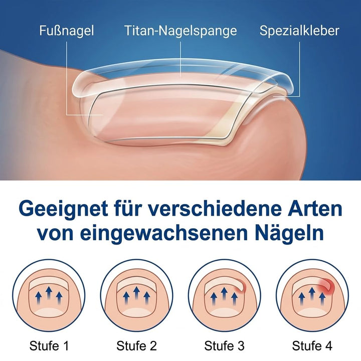 Eingewachsene Zehennägel Set Titan Nagelspange Fussnägel Korrektur, 10 Stück | 1er Pack, 5 Grössen 1