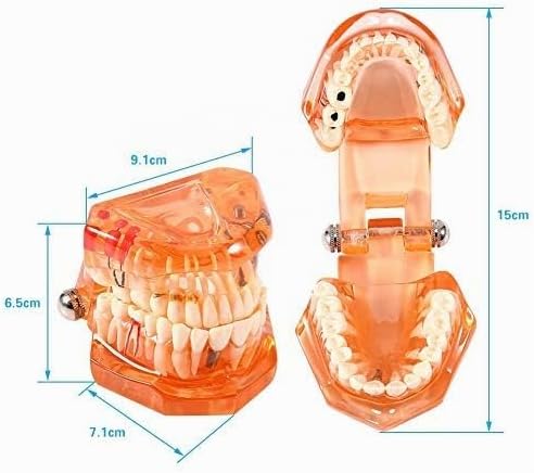 Jadeshay Zahnmodell Dentalmodell, Entfernbares Zahn-Implantat Lehrmodell Zahnarzt Demonstration Werk