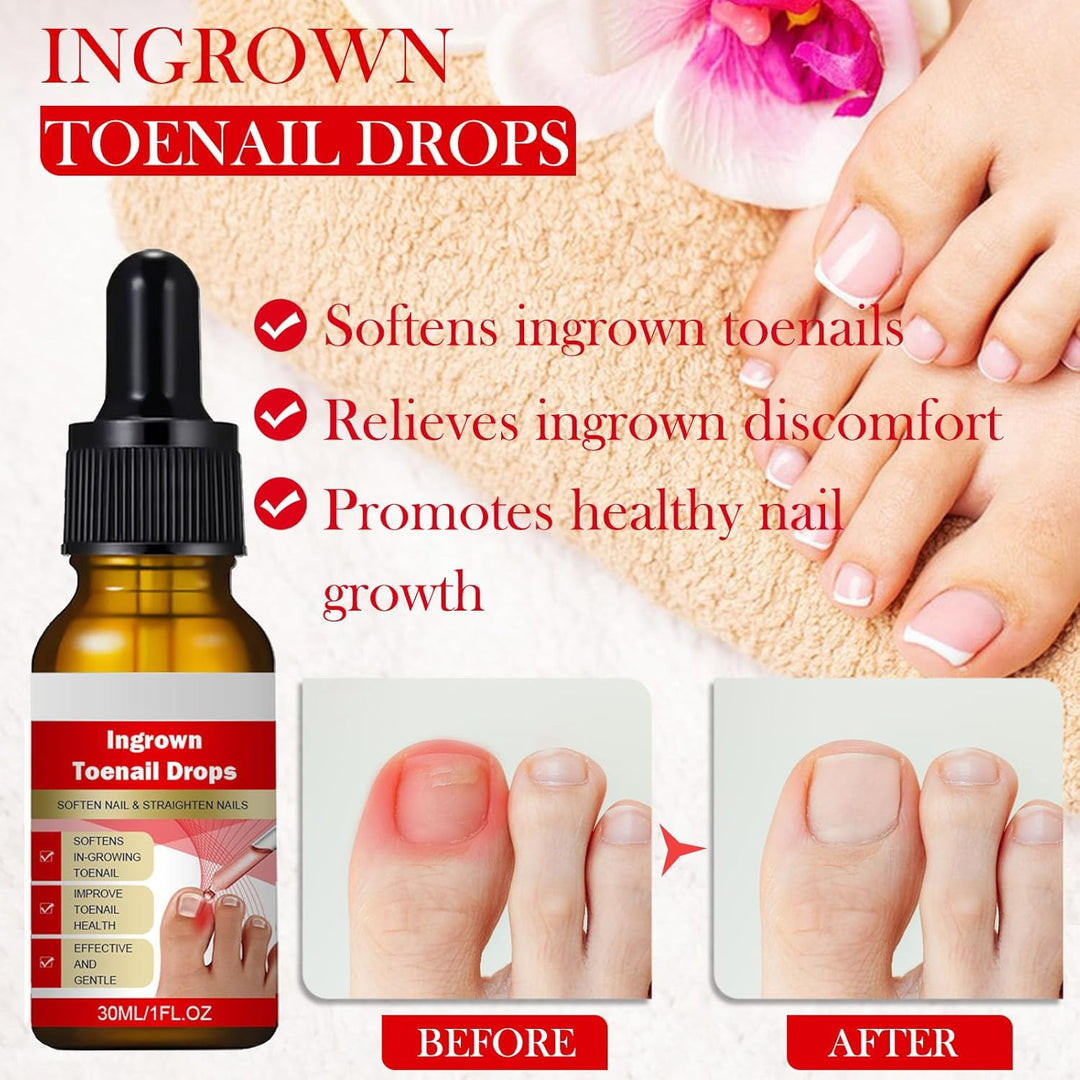 Ingrown Toenail Treatment, ELALRAU Ingrown Toenail Removal Kit with Ingrown Toenail Corrector Drops,
