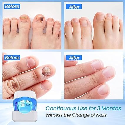 Gerät zur Behandlung von Nagelpilz, Nagelpilz, Fussnägel, Reinigung und Reparatur von Nägeln, Behand