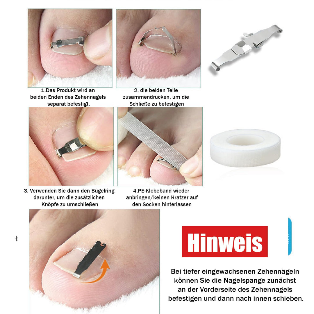 1 Satz Eingewachsene Zehennagel-Werkzeuge, Nagel-Korrekturschnalle, Patch Gebogene Zehennägel Klamme