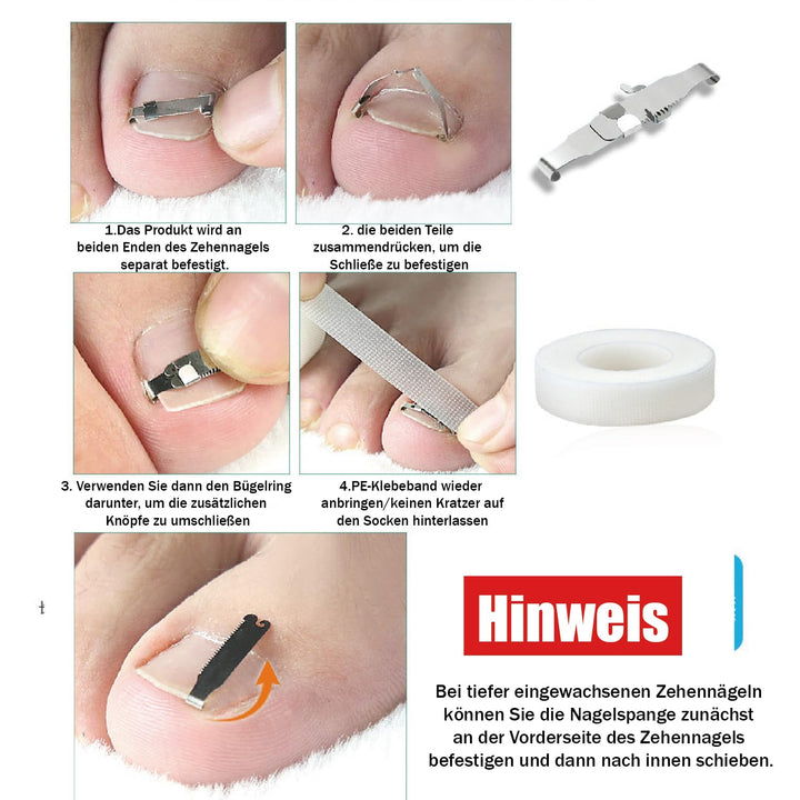 1 Satz Eingewachsene Zehennagel-Werkzeuge, Nagel-Korrekturschnalle, Patch Gebogene Zehennägel Klamme