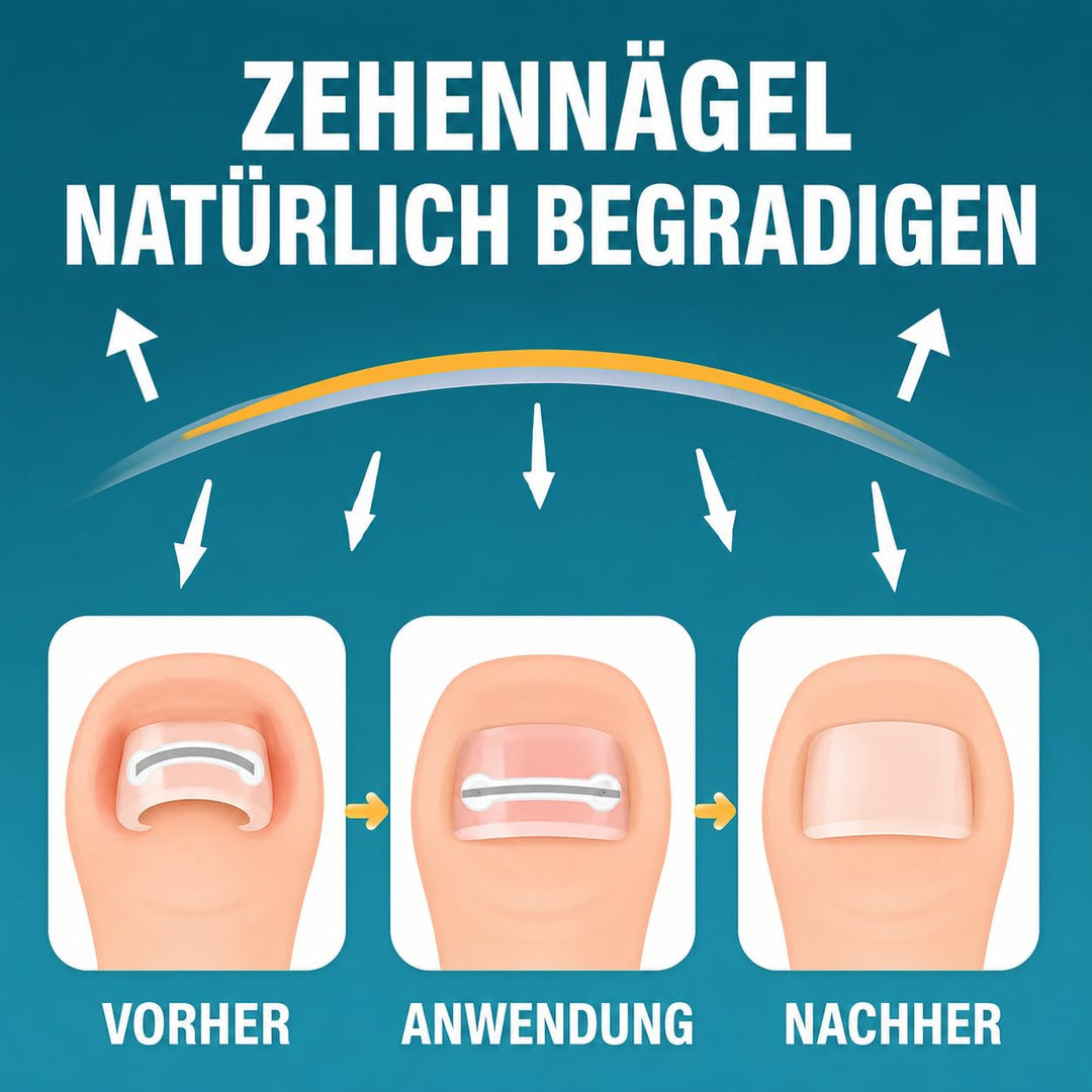 Eingewachsene Zehennägel Set, Zehennagel Korrektur,5 verschiedene Grössen 1 stück (1er Pack), 1 stüc