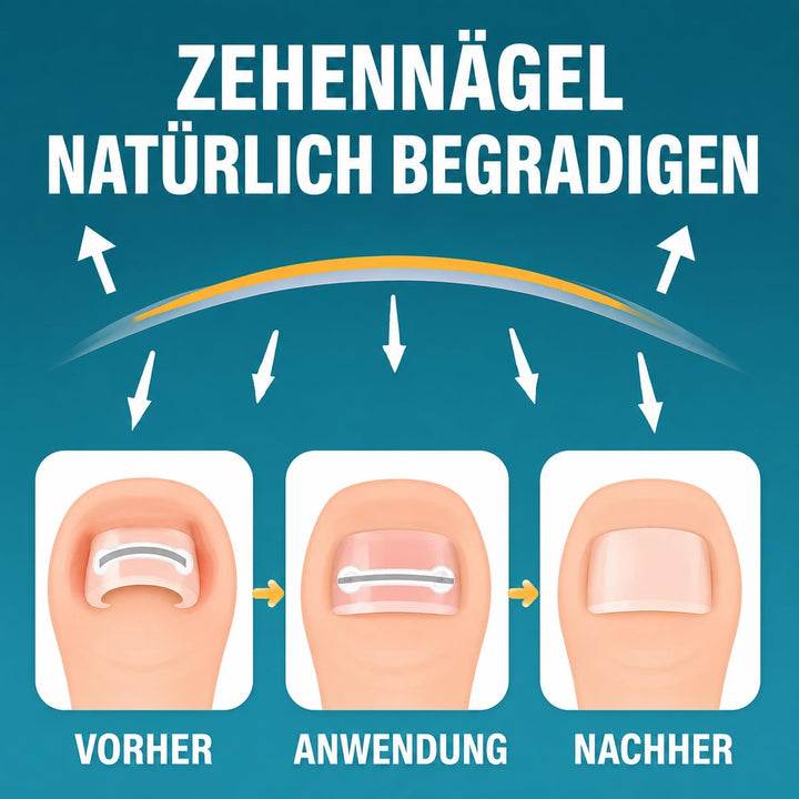 Eingewachsene Zehennägel Set, Zehennagel Korrektur,5 verschiedene Grössen 1 stück (1er Pack), 1 stüc